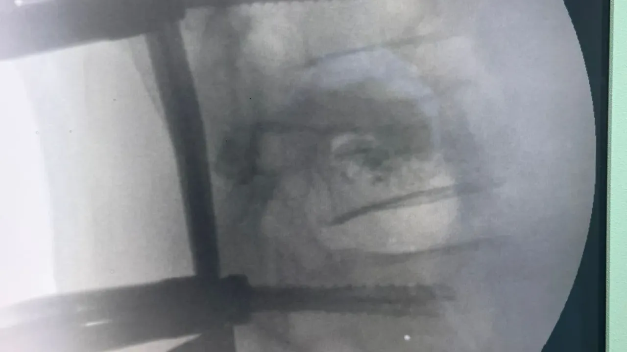 Trabzon’da Omurgasına Vida Takıldı, Sağlığına Kavuştu