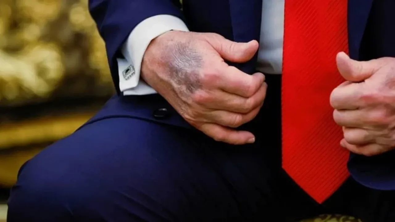 trump ellerindeki morluklarin sebebini acikladi tavsiye edilenden daha yuksek dozda aliyorum wqxm